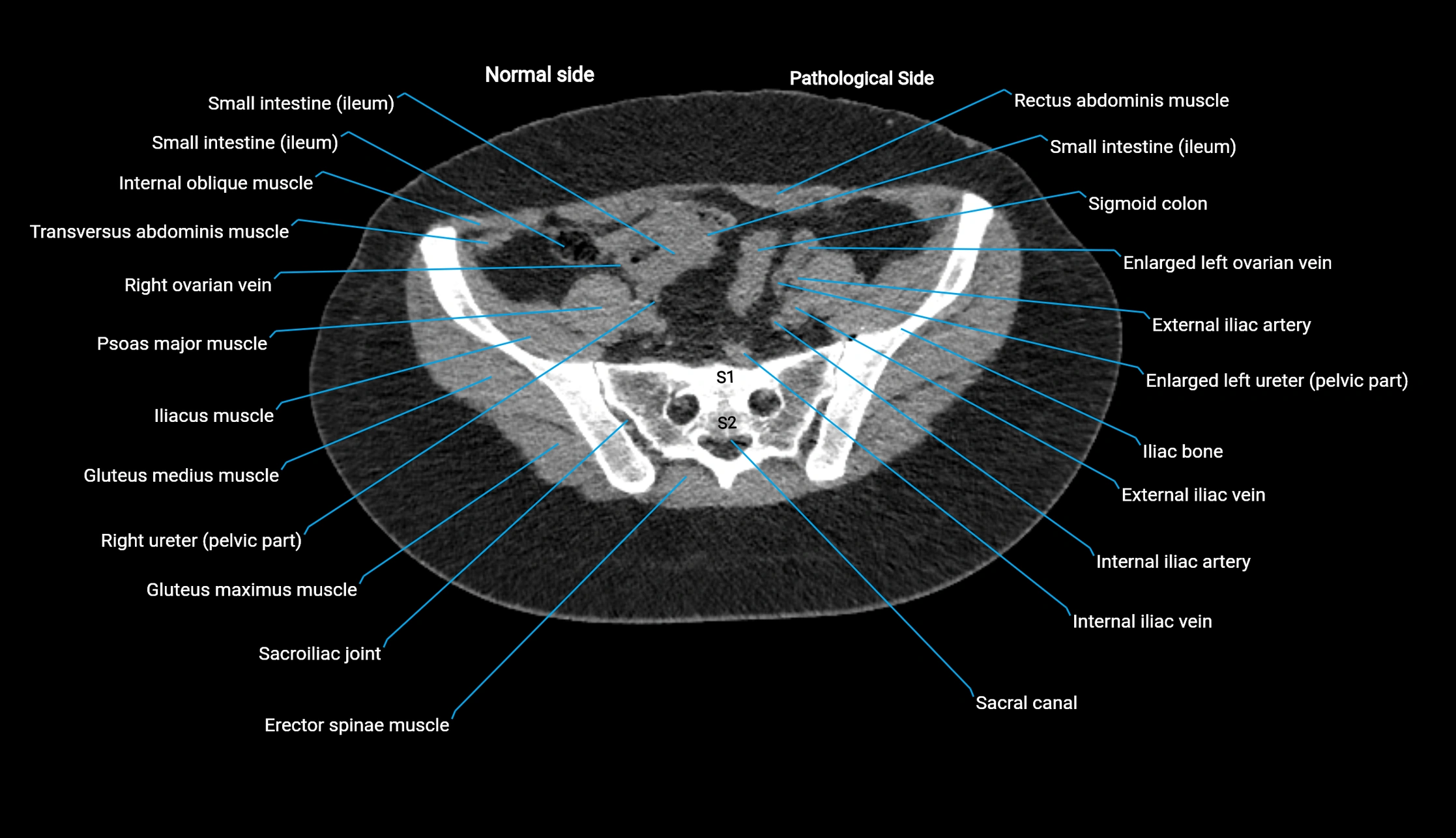 CT KUB axial cross sectional anatomy  radiology image -img-00201-00121.webp
